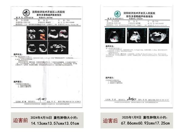 '【腹盆腔囊肿物大小是迫害前的近三十倍】'